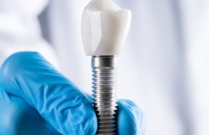Why Should You Use Cylindrical Implants?